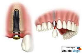    Implant dentar pret avantajos Bucuresti